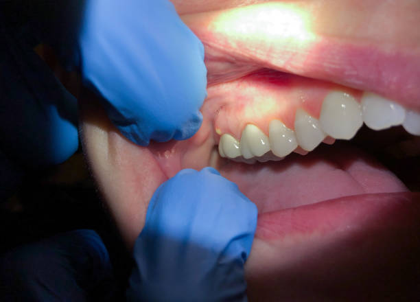 Best Emergency Root Canal Treatment in Mckinney, TX